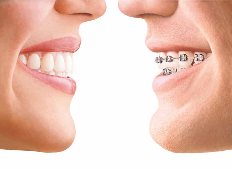 Invisalign vs togskinner